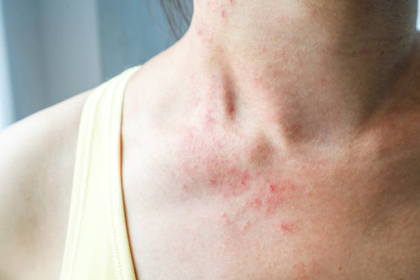 Skin Rashes from Sun Exposure: How to Deal with It